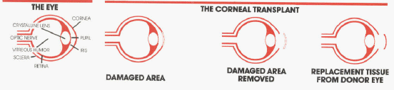 Corneal Transplant